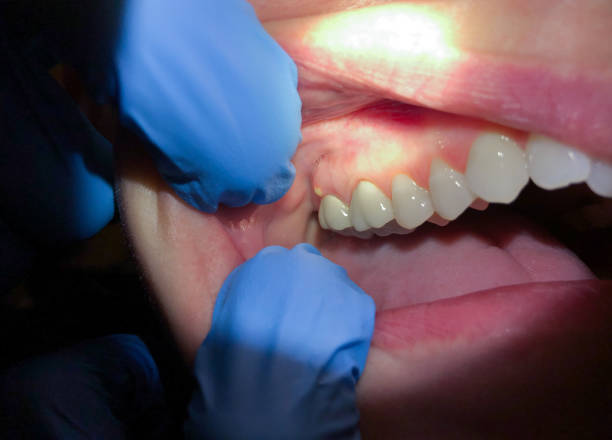 Best Emergency Dental Care for Broken or Chipped Teeth in Cedar Crest, MA
