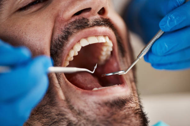 Best Emergency Tooth Extraction in Cedar Crest, MA