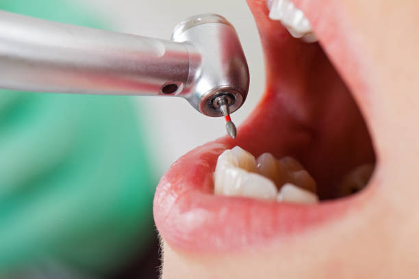 Best Emergency Tooth Extraction in Cedar Crest, MA
